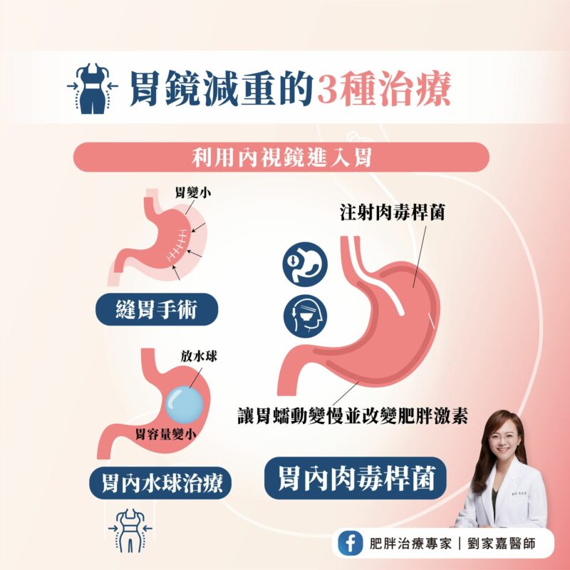 胃鏡減重 治療