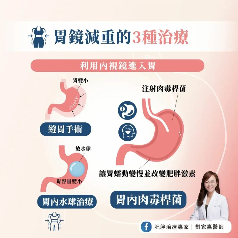 胃鏡減重 治療