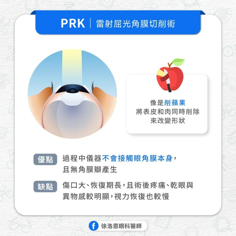 屈光雷射手術 PRK