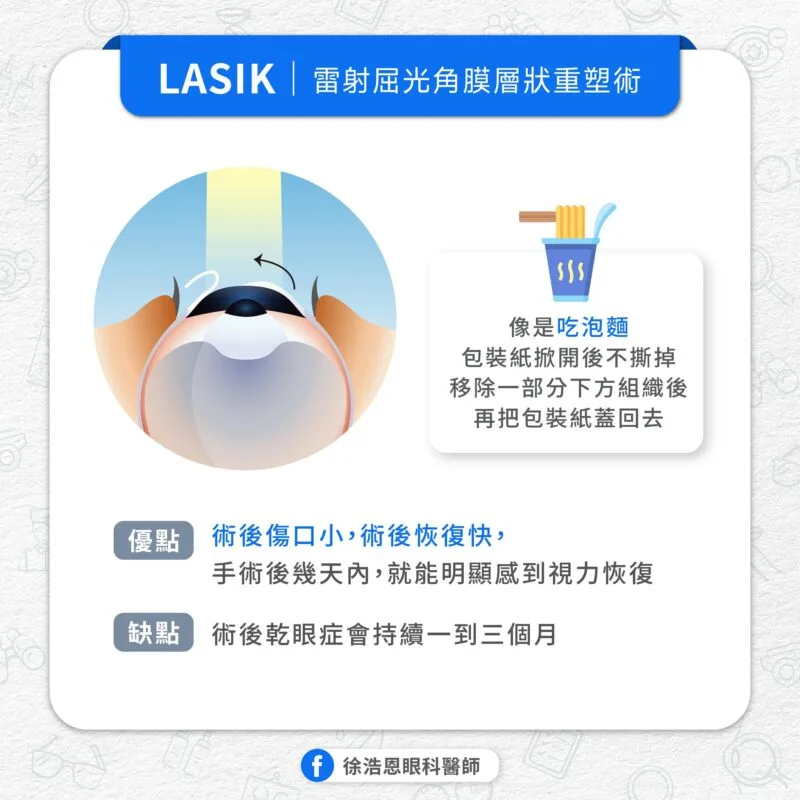 屈光雷射手術 LASIK