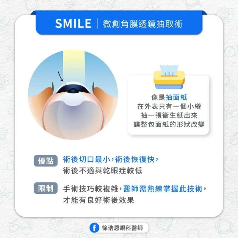 屈光雷射手術 SMILE